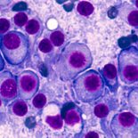 Bone Marrow Aspirate Cytology Of Multiple Myeloma